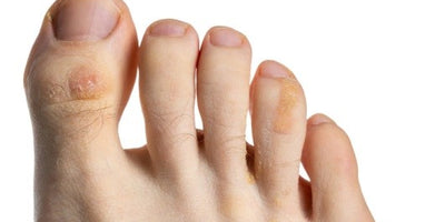 Diferencia entre callo y ampolla