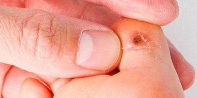 Papiloma en el pie en niños: contagio y tratamiento