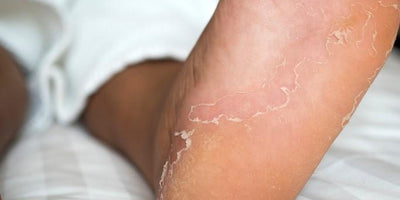 Cómo eliminar los hongos en los pies en una semana