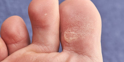 Tipos de callos en los pies