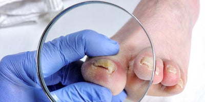 Cómo eliminar hongos en las uñas