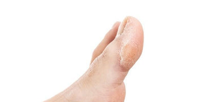 Cómo evitar los callos en los pies