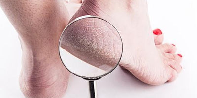 Por qué salen durezas en los pies y cómo quitarlas