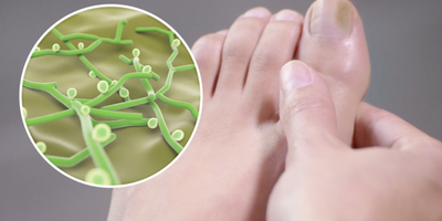 Cómo eliminar los hongos en las uñas de los pies