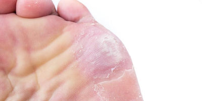 Hongos en los pies: síntomas, tratamiento y prevención