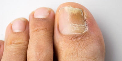 ¿Por qué salen hongos en las uñas de los pies?