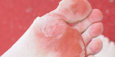 Tipos de hongos en los pies ¡identifícalos!